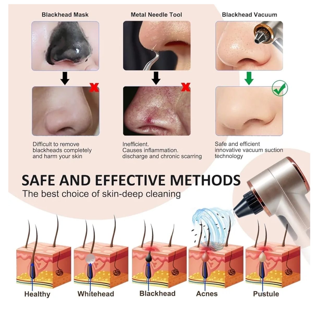 Aspiradora para eliminar puntos negros