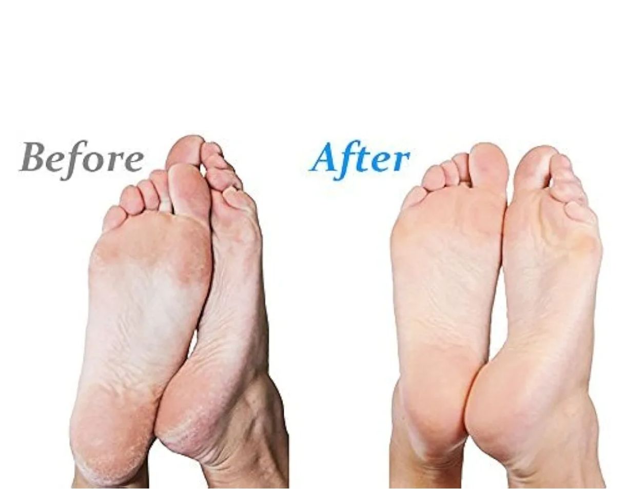 Emjoi Micro-Pedi - Removedor de callos 3D